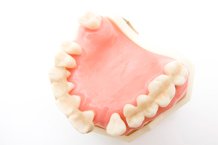 歯周病は歯を失う一番の原因です